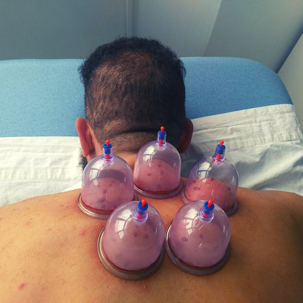 Cupping (Hijamah)
